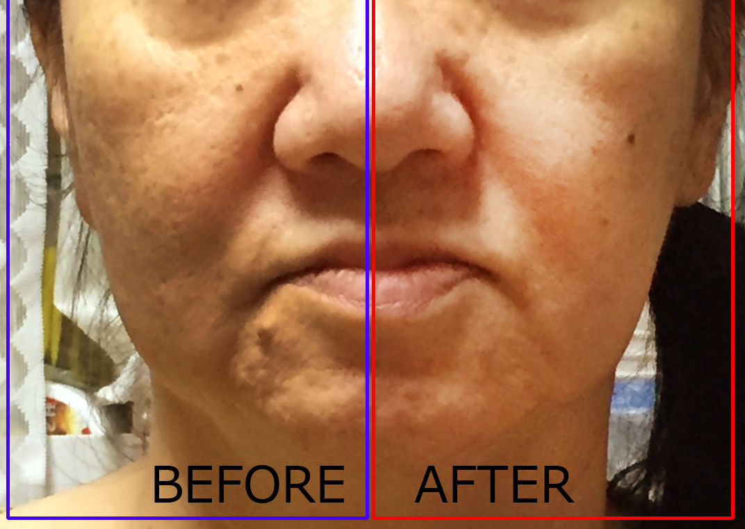 ニューアリフトのビフォーアフター２