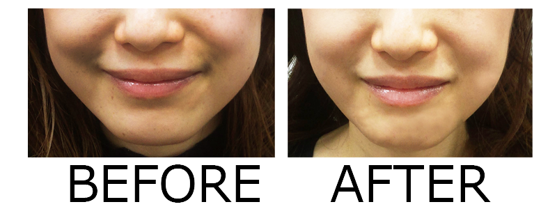 ニューアリフトのビフォーアフター３